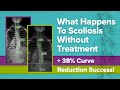 What Happens To Scoliosis Without Treatment   38% Curve Reduction Success!