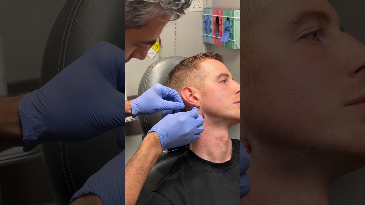 PDO Thread: Non-Surgical Neck Lift | Bellevue | Kirkland | Seattle