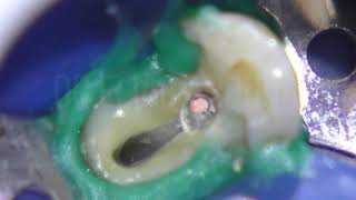 Abboud - Warm Vertical Compaction Technique 1