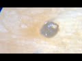 埋没毛掘り［Ingrown hair］3