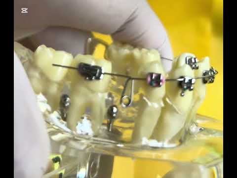 How to make closing loop for space closure in orthodontic treatment!