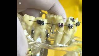 How to make closing loop for space closure in orthodontic treatment!
