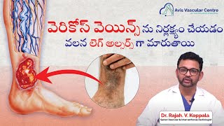 Dr Rajah V Koppala explains the effects of varicose veins on the skin