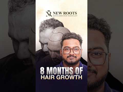 Hair Transplant in Kolkata: Grade 3 Baldness | Patient Review | Cost and Best Results #shorts