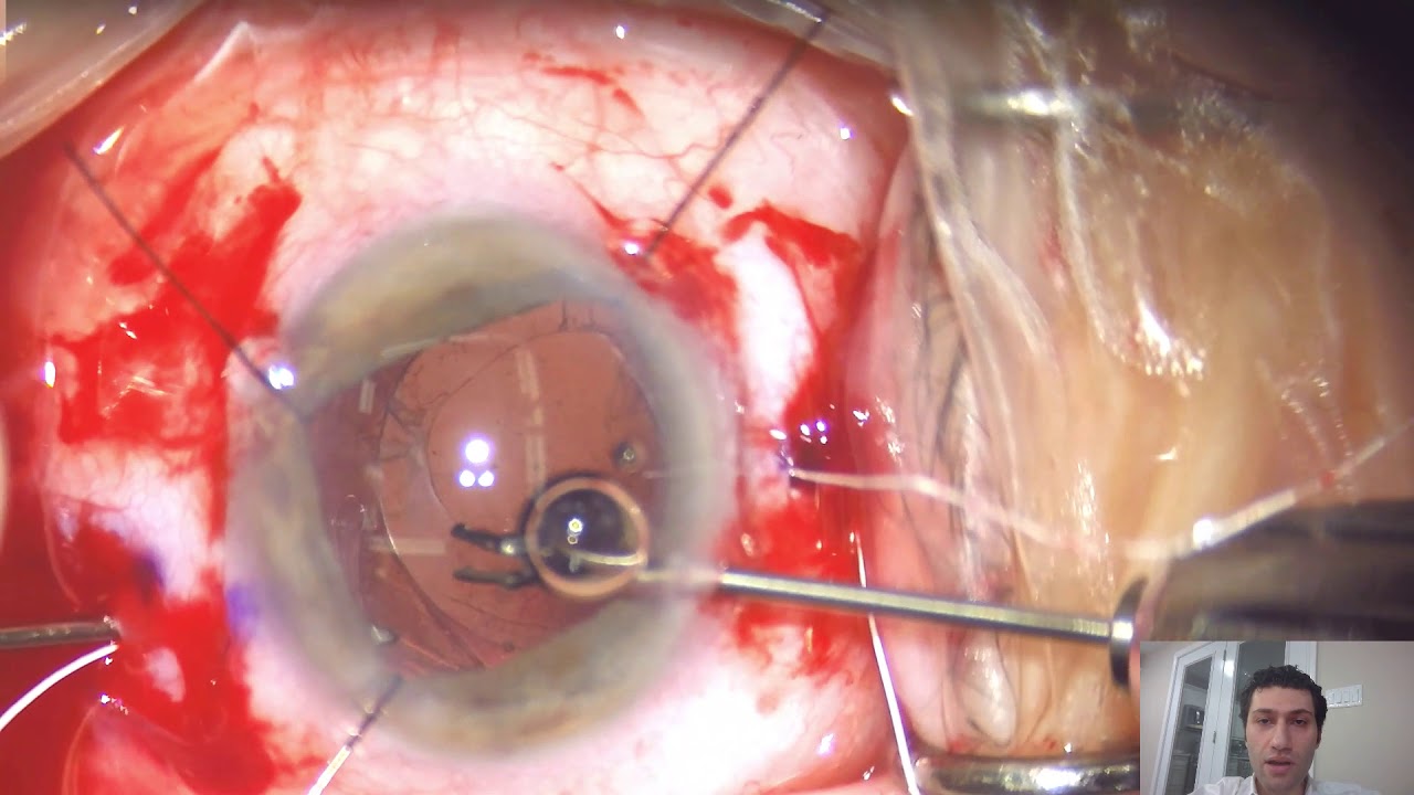 Repositioning of a Dislocated Capsular Bag-Capsular Tension Ring-IOL Complex - Lasso-CTR Technique