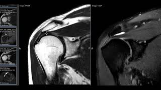 Rotator cuff impingement and bursitis