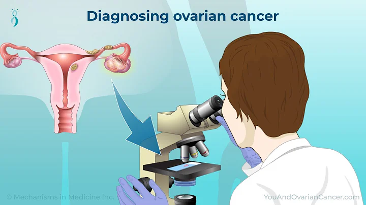 Diagnosing Ovarian Cancer - DayDayNews