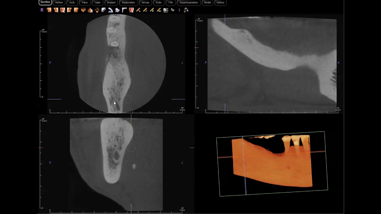 Incidental sialolith