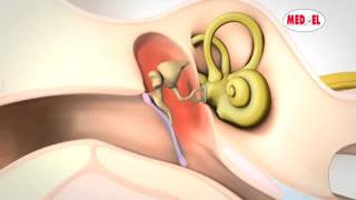 Conductive Hearing Loss Explained   MED EL