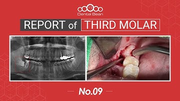 [MULTI_SUB] Extraction of horizontal Rt. Mn third molar - [Dr. Cho Yongseok]