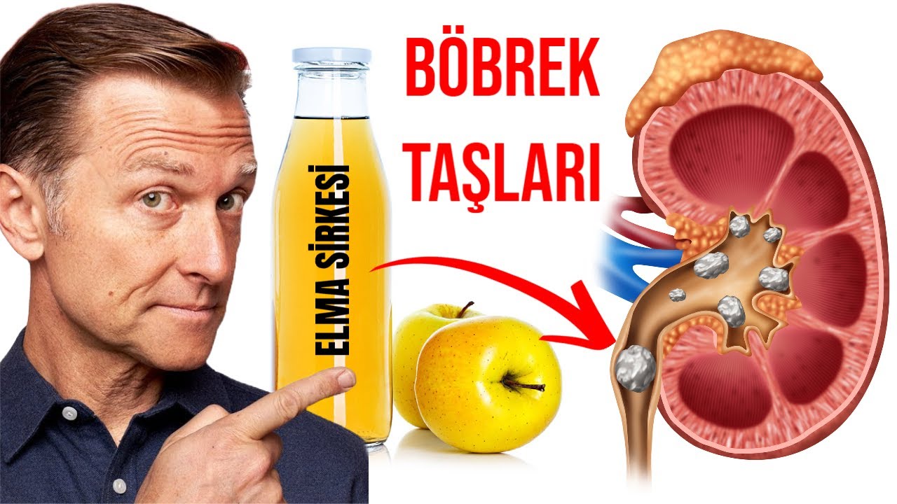 Böbrek Taşlarını Eritmek İçin Elma Sirkesi bu şekilde Kullanın | Dr.Berg Türkçe