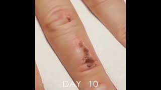 WOUND HEALING TIMELAPSE⚕️♥️