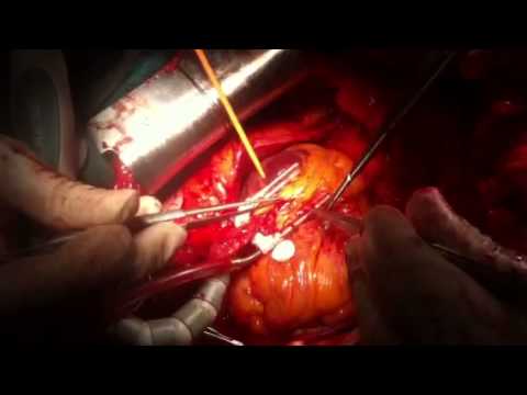lima lad anastomosis on beating heart youtube