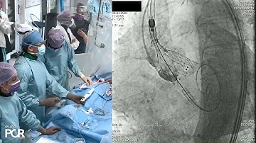 Contemporary TAVI: the VISION of lifetime management - EuroPCR 2024