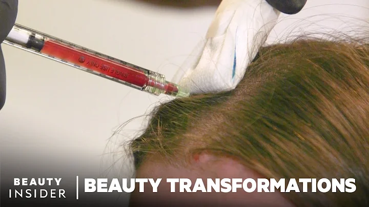 How To Restore Hair Growth With Platelet-Rich Fibrin | Beauty Transformations