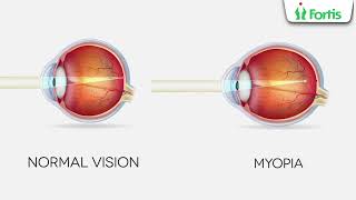 Understanding Childhood Myopia: Insights from Dr. Arvind Kumar