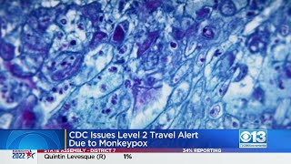 5th Presumptive Case Of Monkeypox Detected In Sacramento County