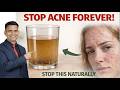 How To Get Rid Of Acne Naturally | Acne Treatment Naturally in 3 days
