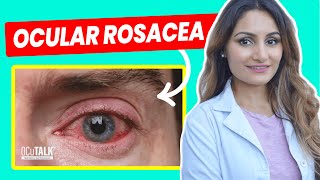 Ocular Rosacea and Dry Eye | How can rosacea affect your eyes?