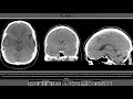 Condition Specific Radiology: Cerebral Cavernous Malformation