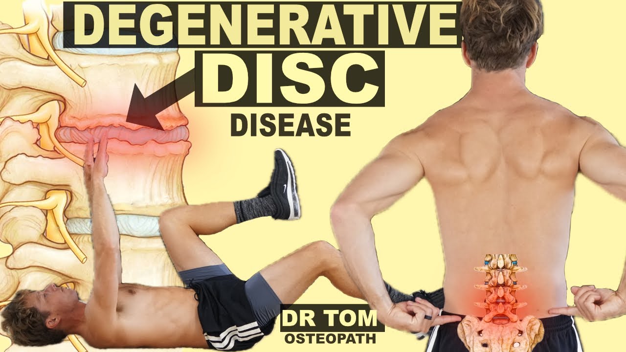 Disc Degenerative Disease | 5 BEST Exercises