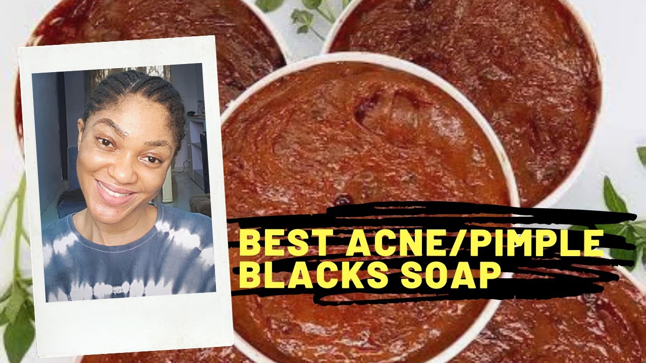 Используйте это, чтобы избавиться от прыщей / Как смешать черное мыло от прыщей, чтобы получить б...