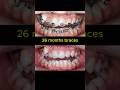 Braces journey. 26 months to complete #braces #dentist #orthodontist #teeth