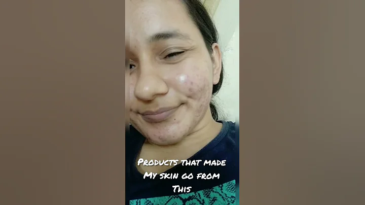 #shorts Part 1 Products which helped me with my acne💫