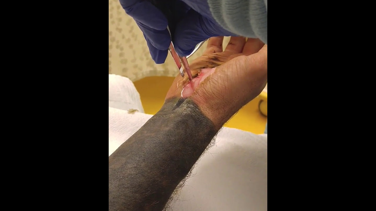 Wound care for 2nd degree burn. ***NOT FOR THE SQUEAMISH