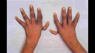 Fanconi Anemia Signs,Symptoms, Causes, Treatment