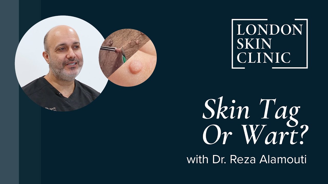 Skin Tag or Wart? | How to Tell the Difference | London Skin Clinic ...