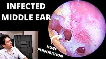 The Worst Ear Infection (Suppurative Otitis Media)