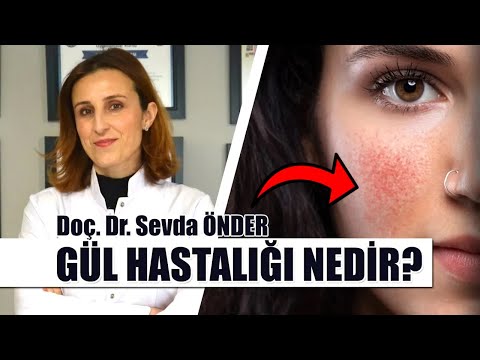 Gül Hastalığı (Rozasea) Nedir! Gül Hastalığı'nın Tedavisi Nasıl Yapılır? | Doç. Dr. Sevda ÖNDER.