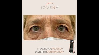 jovena ®  - trattamento occhi non invasivo - face remodelling treatment - soft surgery! screenshot 4