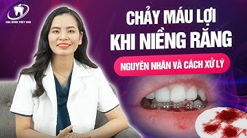 Chảy máu lợi khi niềng răng phải làm thế nào? - Nha khoa dành cho mọi người