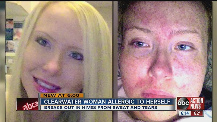 Julie Reid, 28, suffers from Cholinergic Urticaria...