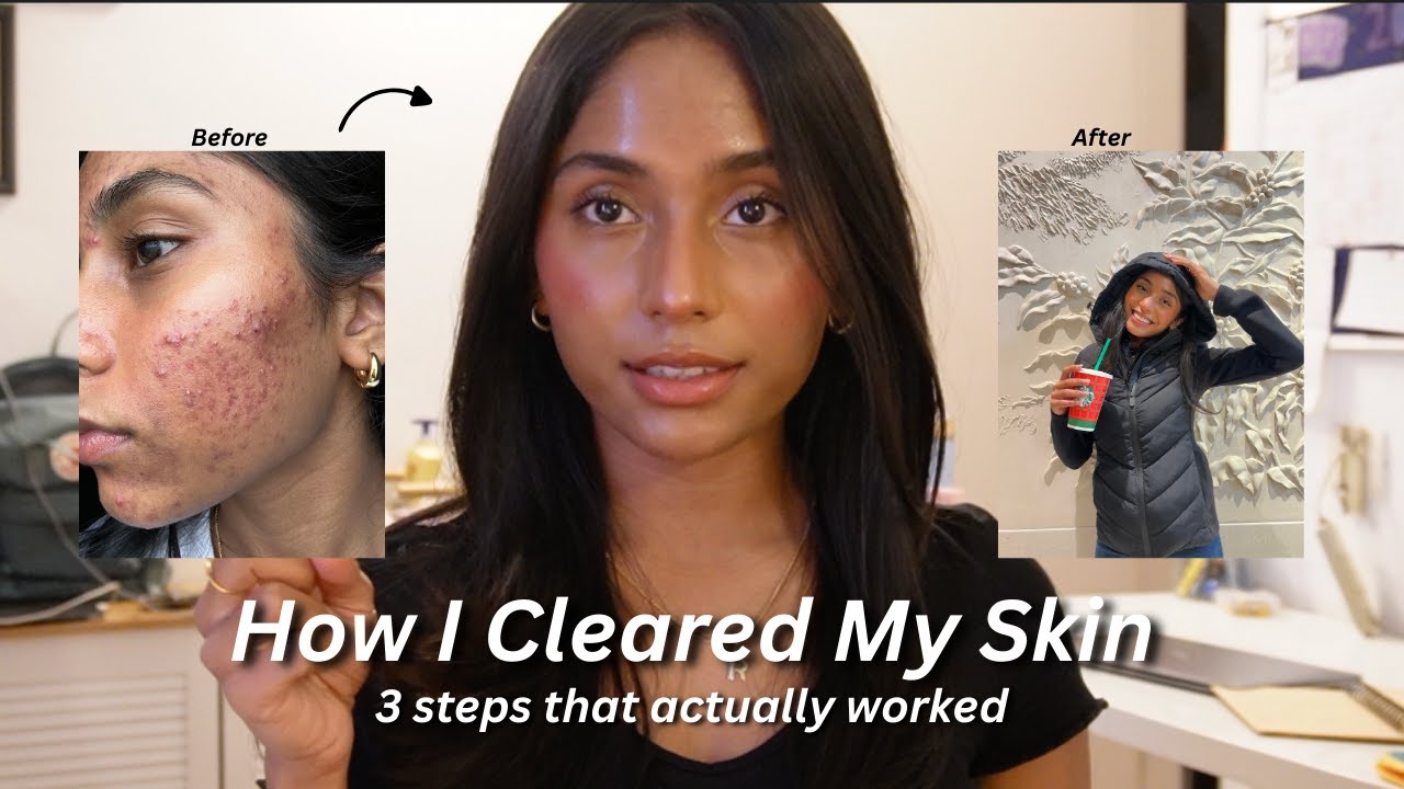 My Acne Transformation: 3 Things That ACTUALLY Worked - YouTube