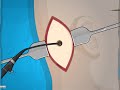 Operate now  eardrum surgery  surgery games for kids
