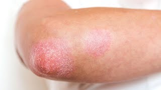 How To Treat Psoriasis on Elbows