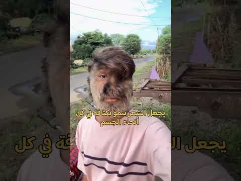 رجل يعاني من مرض نادر يجعل الشعر يغطي جسده بالكامل هل سمعت بهذا من قبل 