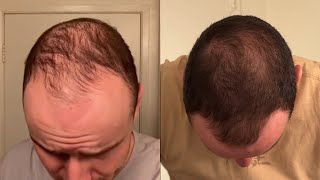 What actually works for hair growth