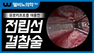 리얼치료 4회 - 유로리프트를 이용한 전립선결찰술