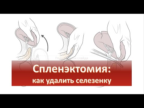 Видео: Что такое селезеночно-почечная связка?