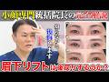 【まぶたのたるみ】「眉下リフトは戻る」って本当?医師が本音で答えます