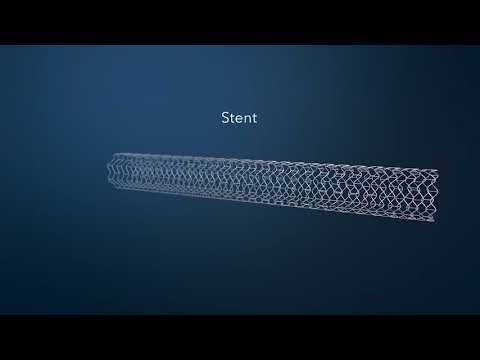 Alap Jani MD Stent Placement