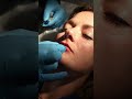 Lip Fillers: Timeless Beauty Secret!