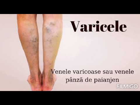Varicele | varilogic.ro