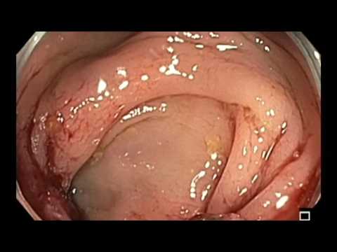 Video: Sigmoid Colon Tumor - Symptomen En Behandeling