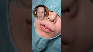 Жах чи подобається? #skincareroutine #botox #lips