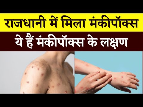 Monkey Pox Symptoms Explained in Hindi | Monkeypox in India | What is Monkey Pox? मंकीपॉक्स क्या है